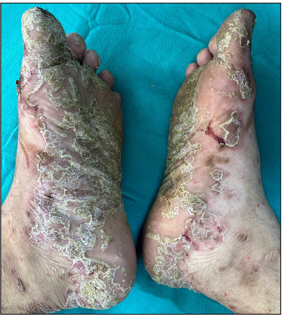 Keratoderma blenorrhagica over soles.