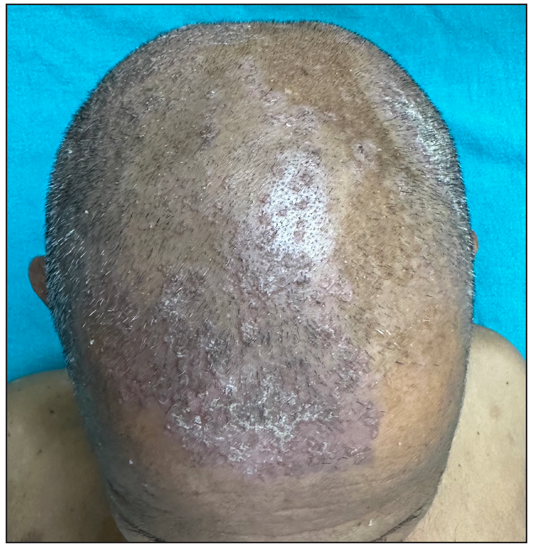 Crusted papules and plaques over scalp.