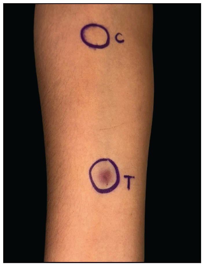 Positive autoerythrocyte sensitisation test (AEST) after 24 hours, as seen on the flexor aspect of the right forearm (C-control, T-test).