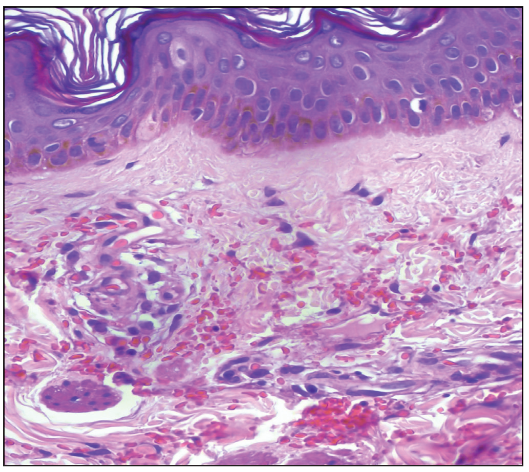 Histopathology showing extravasation of red blood cells from small dermal vessels without vasculitis (Haematoxylin and eosin, 40x).