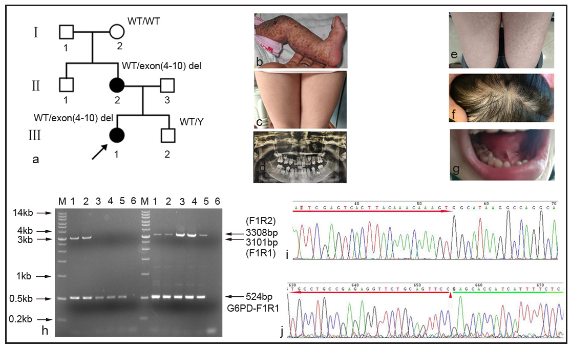 Detection of IKBKG exon 4 to exon–10 deletion using novel gap-PCR in Family 1. (a) There were seven individuals in family 1. exon 4 to exon 10 deletion was observed in the proband (III1) and her mother (II 2). arrow: the proband. WT: wild type; Y: Y chromosome. (b-d) The clinical symptoms of the proband. (e-g). The clinical symptoms of the proband’s mother. (h) The gene-specific gap-PCR using the F1R1 primers yielding a 3101-bp amplicon for exon 4 to exon10 deletion allele. The gene-specific gap-PCR using the F1R2 primers yielding a 3308-bp amplicon for WT allele. A 524bp amplicon was amplified with G6PD-F1/R1 primers for internal control. Lane1: the proband’s mother; Lane2: the proband; Lane3: amniotic fluid cells; Lane4: the proband’s grandmother; Lane5: normal male; Lane6: negative control without DNA, M: DNA marker. G6PD:glucose-6-phosphate dehydrogenase;F1: forward 1;R1: reverse 1;R2: reverse 2. (i) The upstream of the proband’s mother amplicon was specific for IKBKG by sanger sequencing. Red arrow: IKBKG sequence in intron 2. (j) The downstream of the proband’s mother amplicon. triangle: the boundary between the complete MER67B sequence and downstream sequence; red arrow: MER67B sequence; green arrow: downstream sequence. (A: Adenosine, C:Cytosine, G: Guanine, T: Thymine)