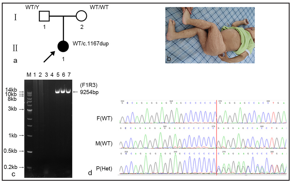 LA-PCR was used for confirmation of variant c.1167dupC in Family 2. (a) There were three individuals in family 2, II1 is the proband. (b) The clinical symptoms of the proband. (c) Agarose electrophoresis showing a 9254-bp amplicon successfully amplified using LA-PCR primers (F1R3). Lanes 1–3: unrelated lanes; lane 4: negative control without DNA; lane 5: father; lane 6: mother; lane 7: the proband. (d) Sanger sequencing showed that the father and mother were wild-type, while the proband was heterozygous. F(WT): father (wild type); M(WT): mother (wild type); P(Het): Proband(heterozygote). (A: Adenosine, C:Cytosine, G: Guanine, T: Thymine)