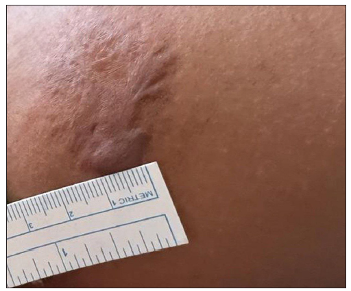 Photograph at the baseline of a patient with four years history of keloid over the right upper arm before treatment with triple combination. (VSS Score = 10)