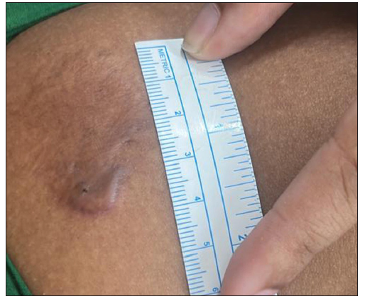 Photograph at the end of 24 weeks of a patient with four years history of keloid over the right upper arm treated with triple combination. (VSS Score = 5)