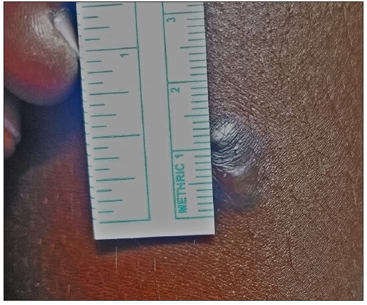 Photograph at the baseline of a patient with seven years history of keloid over the left arm before treatment with triamcinolone acetonide. (VSS Score = 10)