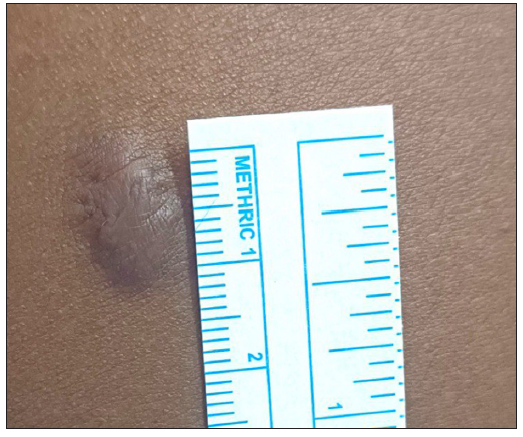 Photograph at the end of 24 weeks of a patient with seven years history of keloid over the left arm treated with triamcinolone acetonide. (VSS Score = 7)