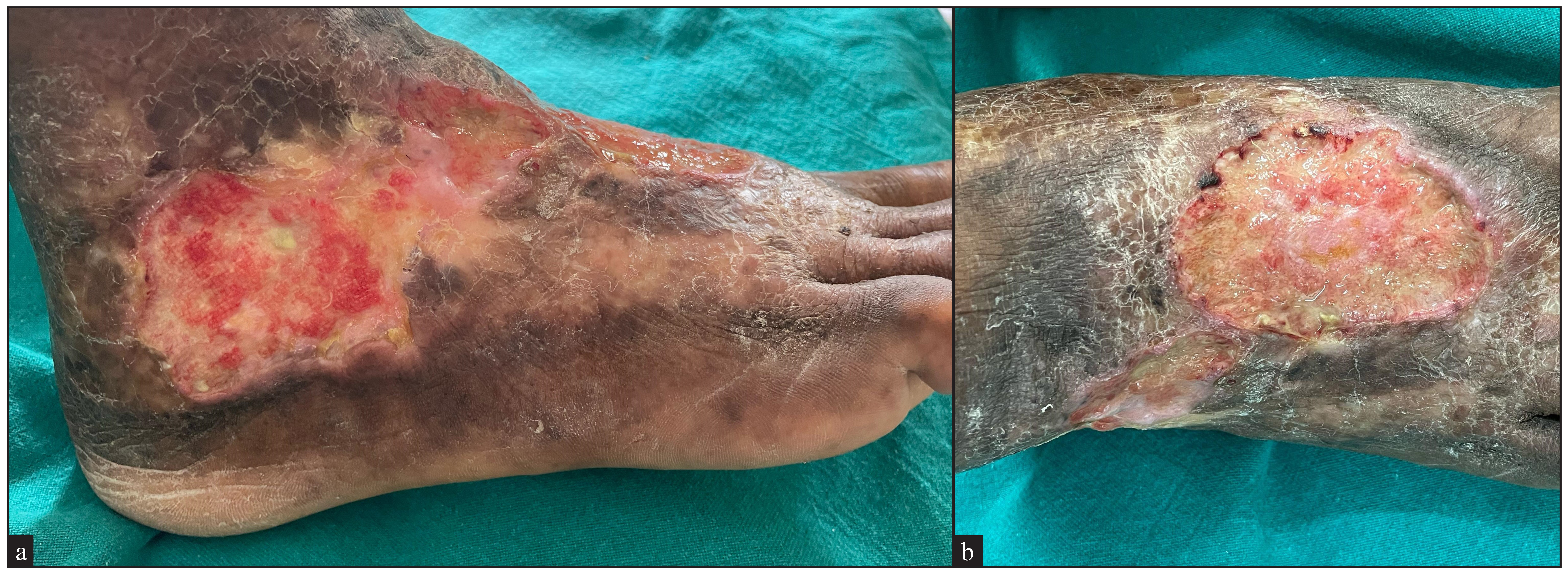 Ulcer with undermined edges and pinkish granulation tissue on the floor with a reepithelization line affecting the a) lateral aspect of the right foot and b) the dorsal aspect of the right foot.