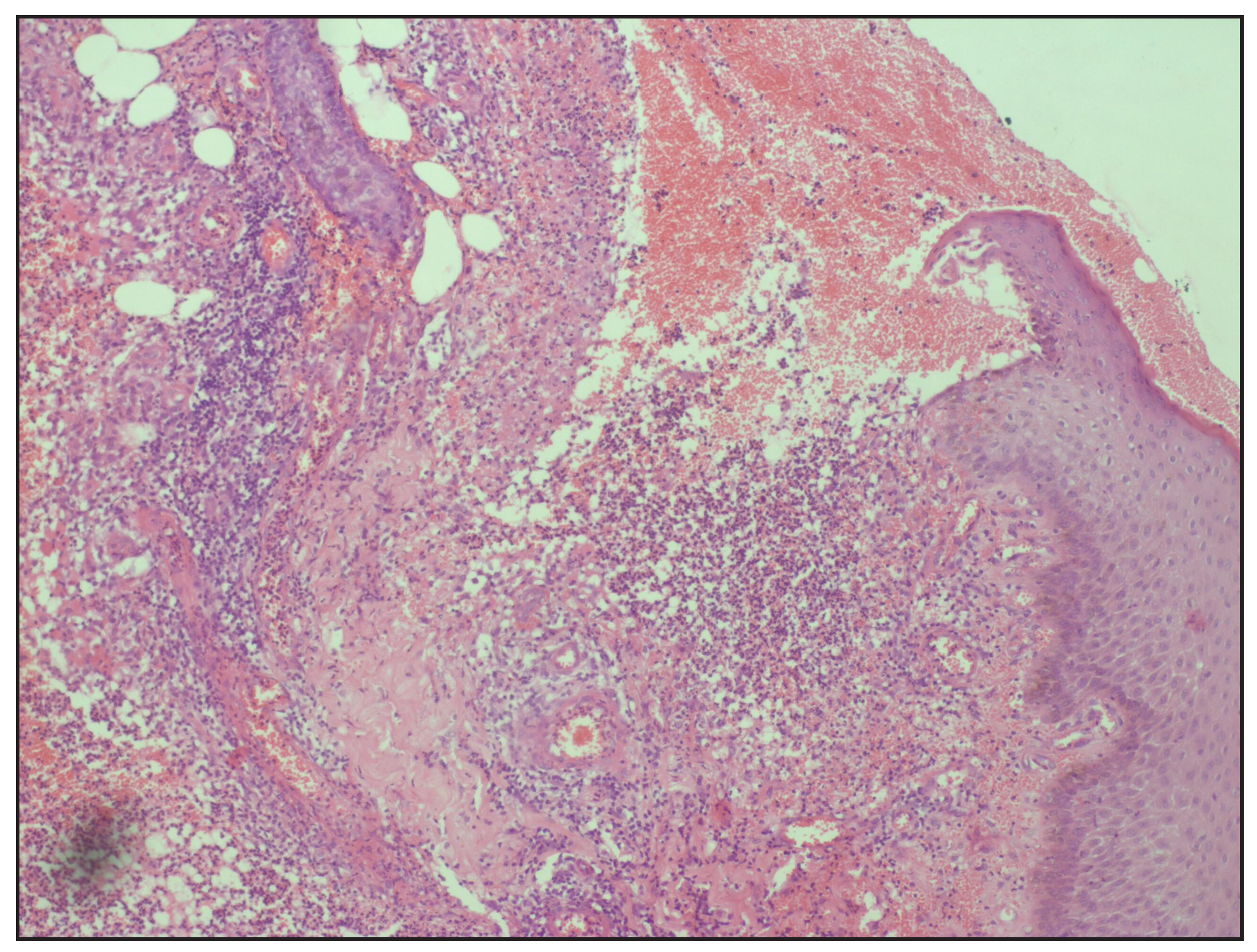 Histopathology revealed sloughing of epidermis in the center with dilated vessels, extravasated RBCs, and dense dermal infiltrate (Haematoxylin and eosin, 100x)