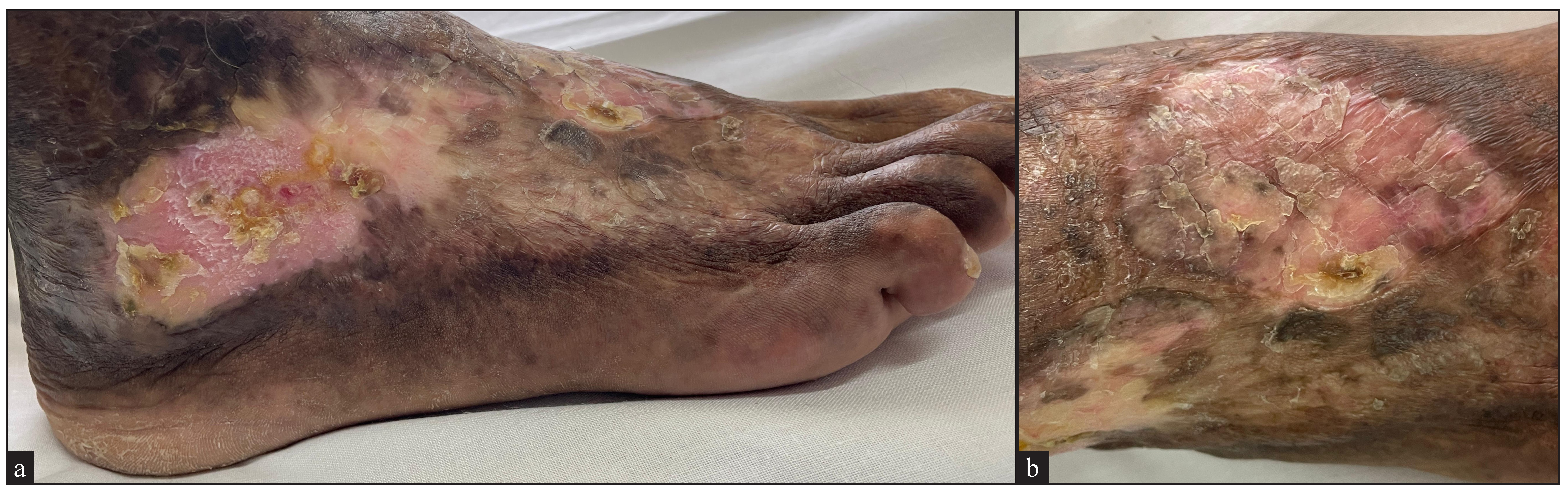 Shows complete re-epthelisation of ulcer over a) lateral aspect of the right foot and b) dorsum of the right foot.