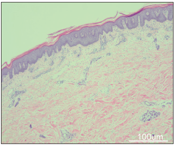 Skin biopsy of a psoriatic lesion showed epidermal hyperkeratosis, neutrophilic infiltration, thinning of the granular layer and regular thickening of the spiny layer (Haematoxylin-eosin, 100x, scale bar, 100 µm).