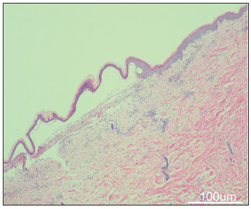 Skin biopsy of blister lesions showed subepidermal blisters with neutrophils and eosinophils infiltrating the blister area (Haematoxylin-eosin, 40x, scale bar, 100 µm).