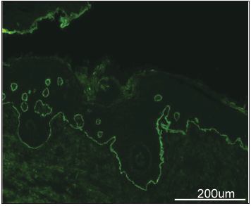 Direct immunofluorescence imaging of blister lesions showed IgG and C3 deposits along the basement membrane zone (200x, scale bar, 200 µm).