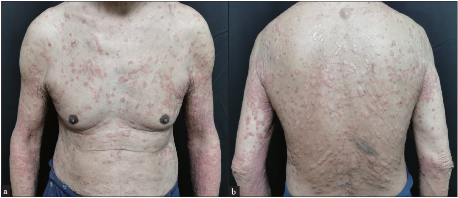 Partial improvement in skin lesions of the trunk and back after 2 weeks of treatment.