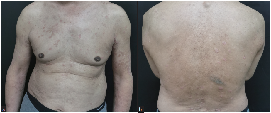 Complete resolution of skin lesions of the trunk and back after 6-weeks of treatment.