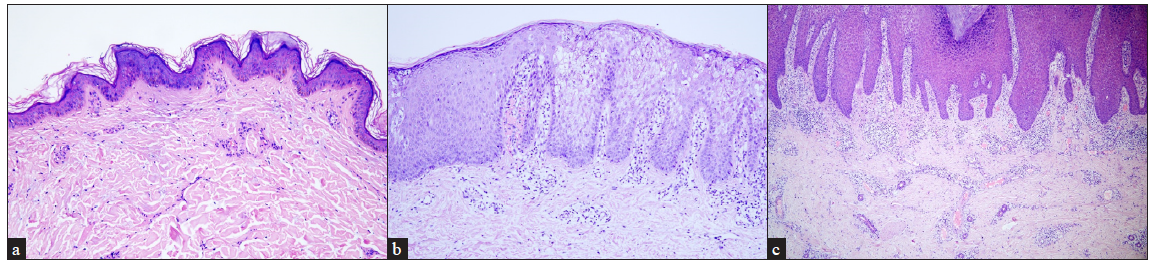 Histopathological features of keratinocytic epidermis naevus. (a) Hyperkeratosis, verrucous acanthosis and papillomatosis in non-epidermolytic epidermal naevus (Haematoxylin and eosin, 100x), (b) Hyperkeratosis, keratinocyte vacuolisation and keratohyalin granules in epidermolytic epidermal naevus (Haematoxylin and eosin, 100x), and (c) Psoriasiform epidermal hyperplasia, orthokeratosis, parakeratosis, marked lymphocyte infiltration in the dermis in inflammatory epidermal naevus (Haematoxylin and eosin, 40x).