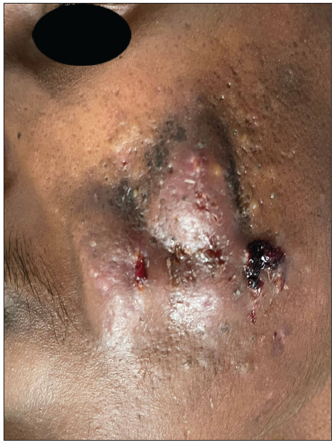 Large nodulocystic acne lesions on left cheek.
