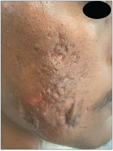Reduction in the Investigator’s Global Acne Assessment Score from 4 to 1 with scarring – right cheek.