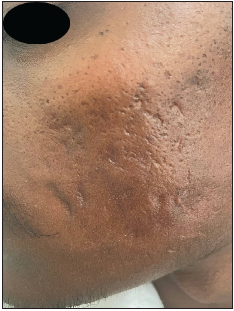 Reduction in Investigator’s Global Acne Assessment Score from 4 to 1 with minimal scarring – left cheek.
