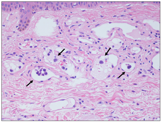 Lymphoma cell (black arrow) in the vessels of the senile haemangioma (Haematoxylin & eosin stain, 400x).