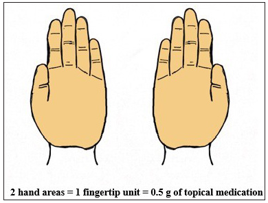 This figure illustrates the ‘rule of hand’, a guideline for dosing topical steroids, where the surface area of the patient’s palm approximates two fingertip units, equivalent to 0.5 g of topical medication, aiding in accurate dosing.