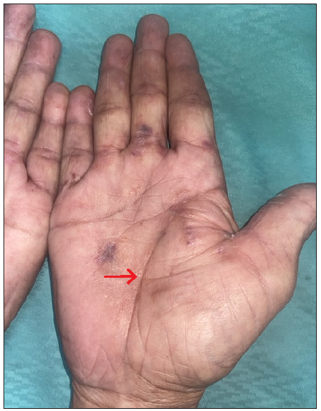 Waxy papules and purpura along the creases of the right palm (indicated by the red arrow).