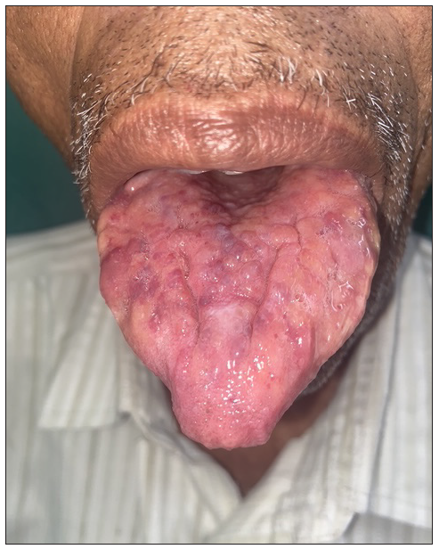 Macroglossia with pebbly surface.
