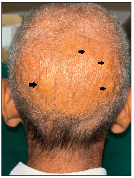 Multiple soft boggy swelling over occiput (black arrows).