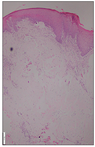 Eosinophilic homogenous deposit in the dermal papilla (Haematoxylin & eosin, 50x).