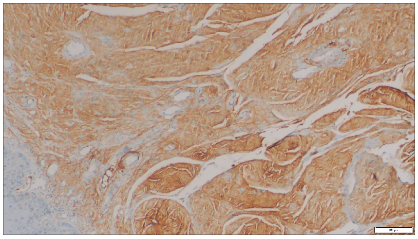 Amyloid associated protein deposits on the dermal region of the tongue (Immunohistochemistry, 50x).