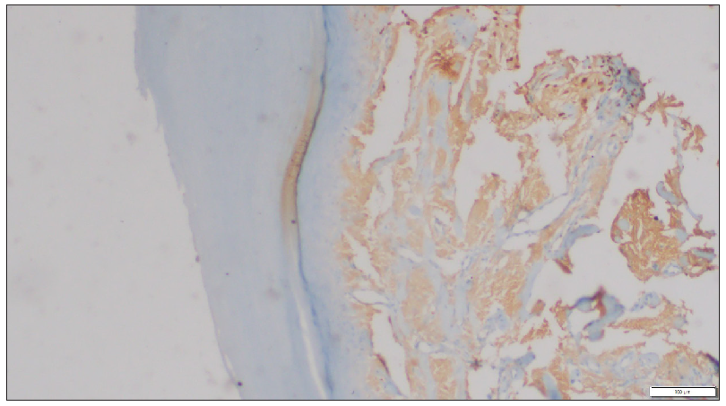 Amyloid-associated protein deposits on the palm (Immunohistochemistry, 50x).