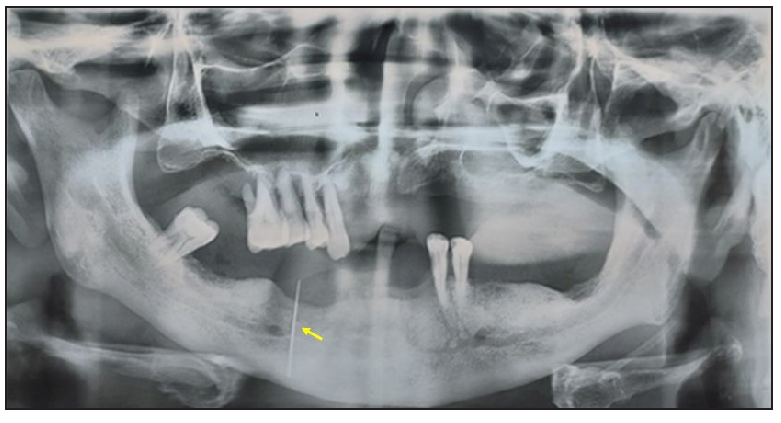 Fistula tracing using Gutta-Percha cone in panoramic radiograph (yellow arrow).