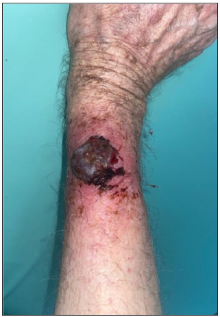 Clinical image of nodular melanoma.