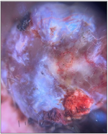 Dermoscopic image of nodular melanoma showing the RP in polarised light (dermoscope dermlite 4, 10x).