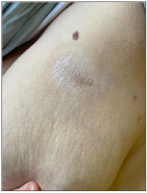 Clinical image of extra genital scleroatrophic lichen of the trunk.