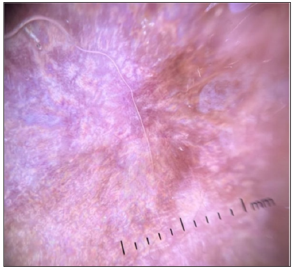Dermoscopic image of extra genital scleroatrophic lichen showing the RP in polarised light (dermoscope dermlite 4,10x).