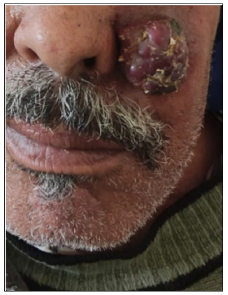 Clinical image of cutaneous metastasis of breast cancer.