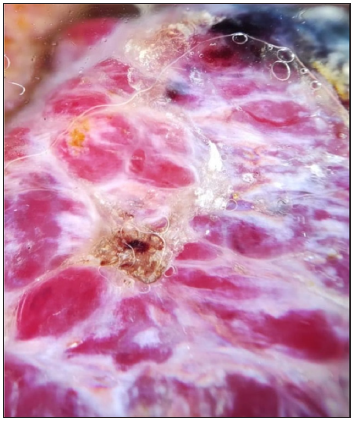 Dermoscopic image of cutaneous metastasis of breast cancer showing the RP in polarised light (dermoscope dermlite 4, 10x).
