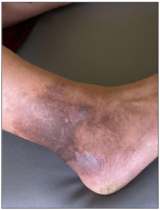Clinical image of lichen planus of the lower third of the leg.
