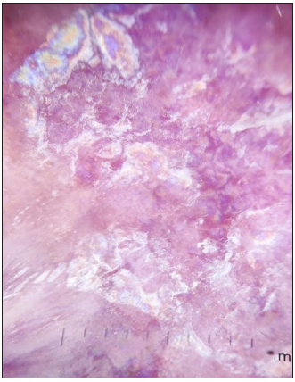 Dermoscopic image of lichen planus showing the RP in polarised light (dermoscope dermlite 4,10x).