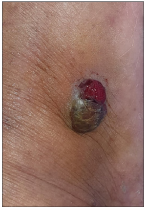 Clinical image of pyogenic granuloma.