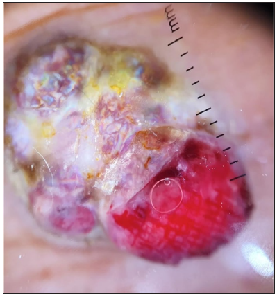 Dermoscopic image of pyogenic granuloma showing the RP in polarised light (dermoscope dermlite 4,10x).