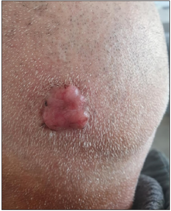 Clinical image of a non-pigmented BCC of the scalp.