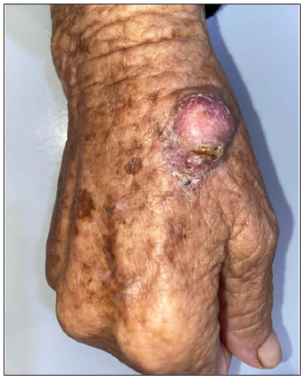 Clinical image of SCC.