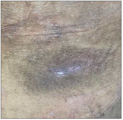 Complete healing of the lesion at two months follow-up.