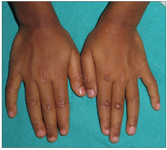 Discrete, flat-topped, firm papules over the bilateral metacarpophalangeal joints and proximal and distal interphalangeal joints.