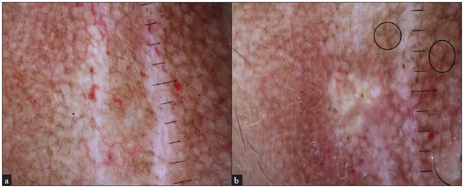 (a) Dermoscopy reveals an arborising telangiectatic vessel, linear white structureless areas and Brown grey globules in a rhomboid pattern suggestive of poikiloderma changes. (b) Yellow-white structureless area suggestive of calcinosis cutis (Hiene Delta 20T, Polarised mode, 10x).