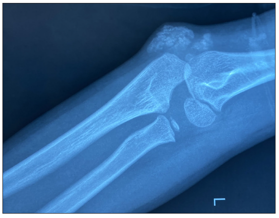 X-ray demonstrating radiopaque mass over extensor of left elbow.