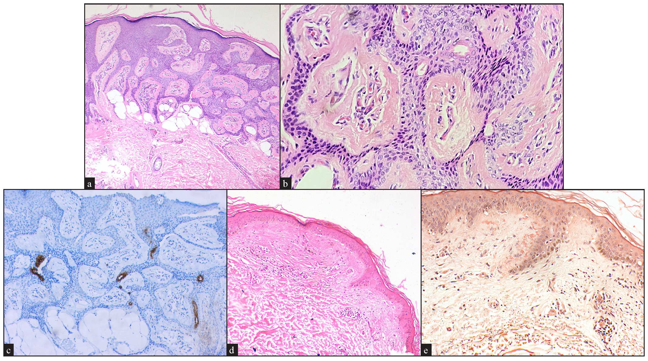 Histopathological pictures showing anastomosing cords of epithelium connected to the undersurface of the epidermis (Haematoxylin and eosin, 40x). (b) Higher magnification revealing the ductal structures (Haematoxylin and eosin, 100x), (c) Immunohistochemical staining showing positivity to carcinoembryonic antigen (CEA), 100x, (d) Microphotograph showing pink globules deposition in the papillary dermis (Haematoxylin and eosin, 40x), (e) Congo red positivity to confirm the amyloid nature of the globules (Congo red stain, 100x).