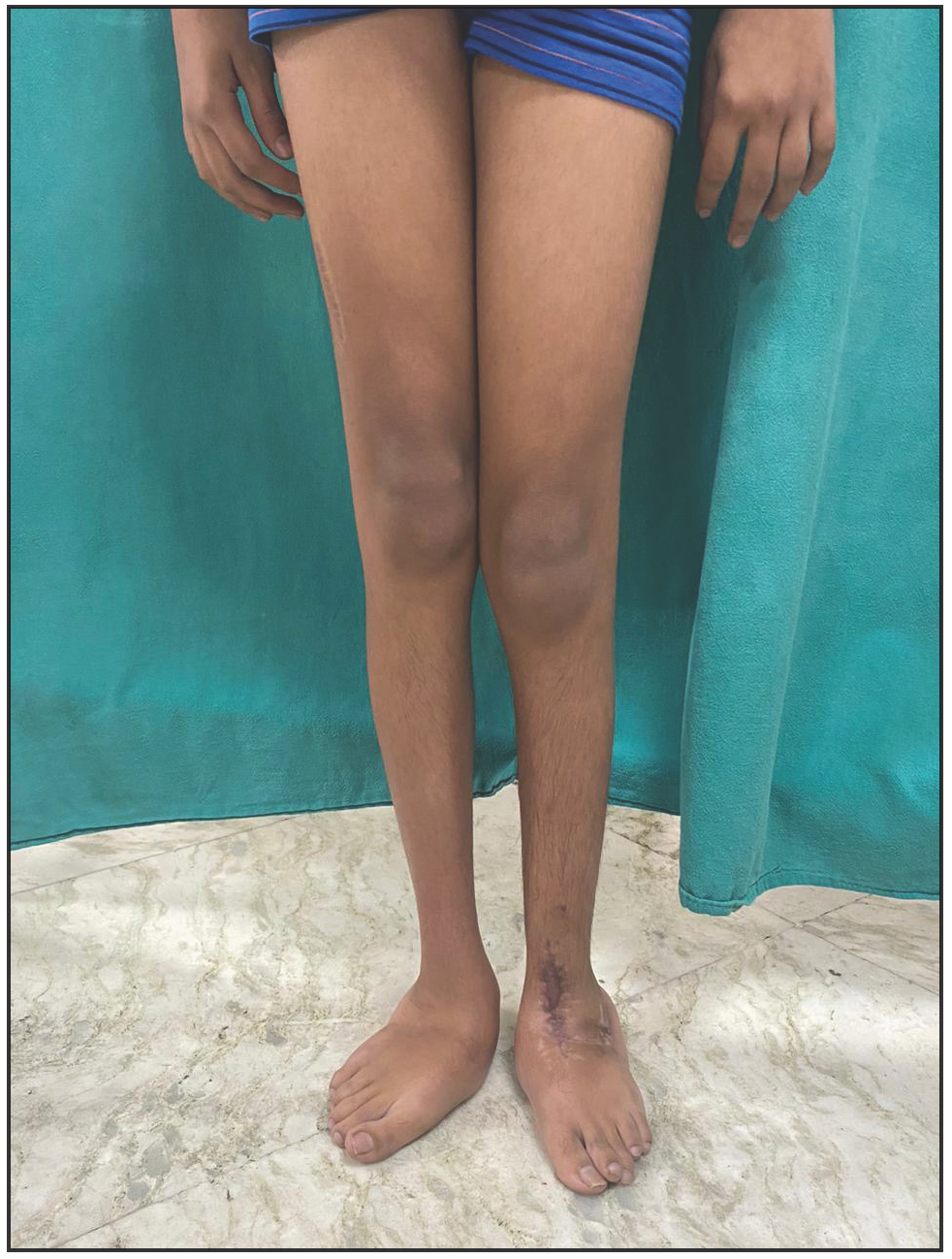 Hallux valgus and long slender extremities (marfanoid habitus). A surgical scar likely due to talonavicular reposition surgery can be seen on the left foot.