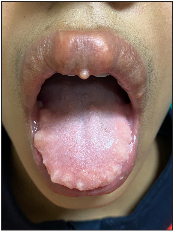 Multiple yellowish nodules on the lips and anterior tongue associated with macrocheilia.